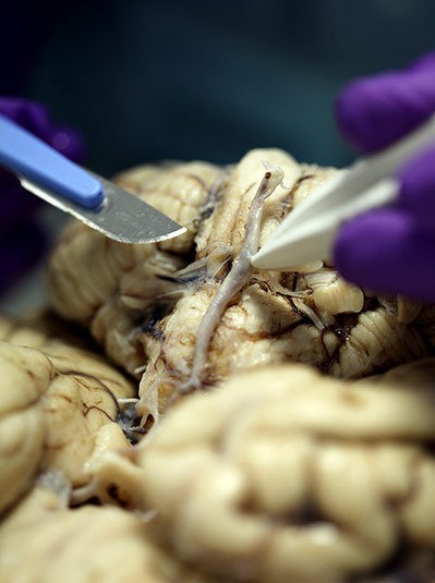 恐怖的大脑解剖过程 苍白的血管清晰可见