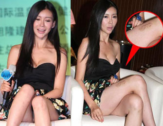 巩新亮穿低胸短裙大腿现淤青