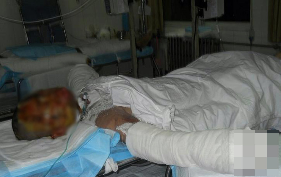 合肥：中学生求爱不成泼汽油焚烧17岁少女