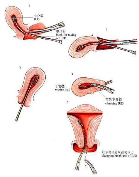 图解:女人上节育环的全过程(图)