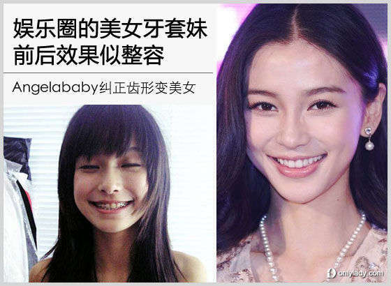 娱乐圈美女牙套妹 前后效果似整容