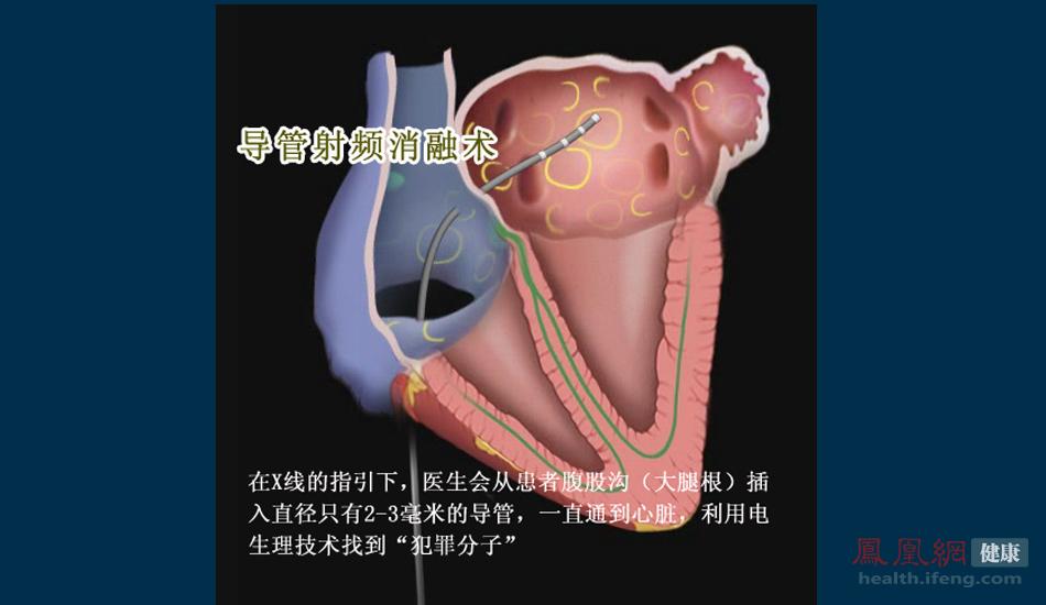 中国医院现场直击：房颤经导管射频消融术