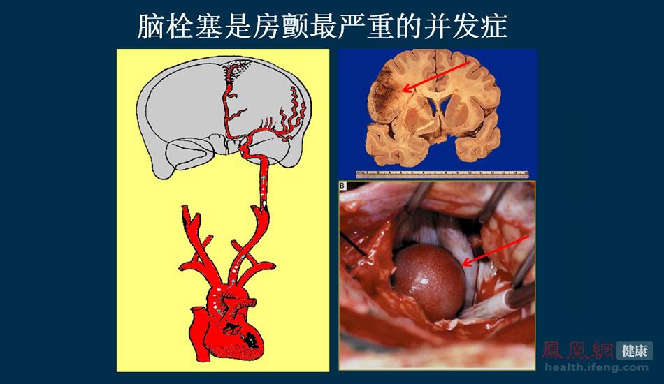 中国医院现场直击：房颤经导管射频消融术