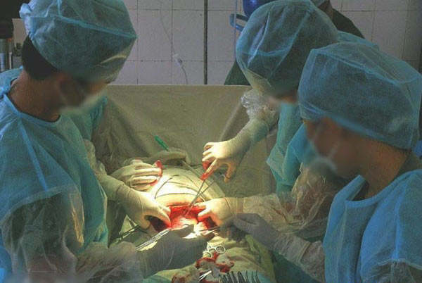 现场直击剖腹产手术全过程
