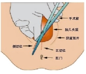 会阴侧切术步骤图，分娩过程中扩大阴道口的外科手术