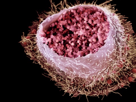 揭秘:女性私密处癌病变真相(图)