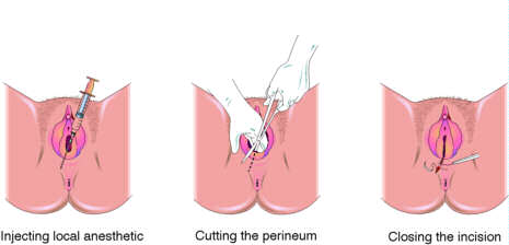 产妇分娩时的侧切缝合(图)|侧切|女人分娩_凤凰