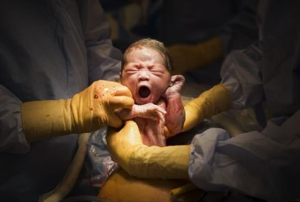 实拍:剖腹产宝宝出生瞬间