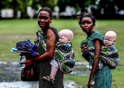 被像动物一样猎杀的白化病黑人