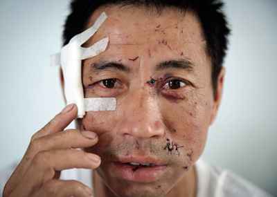 爆炸幸存者讲述生死瞬间