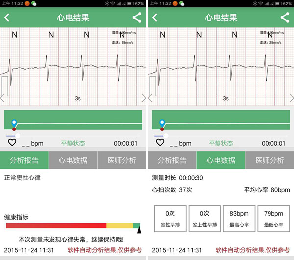 生成单道心电图,同时,用户可以在手机app中查看针对心电图的心律分析