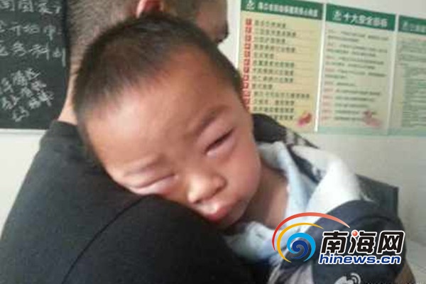 海南:男童疑因用错药输液脸变肿院方称过敏(图