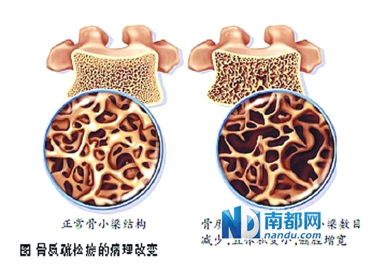 正常骨小梁结构