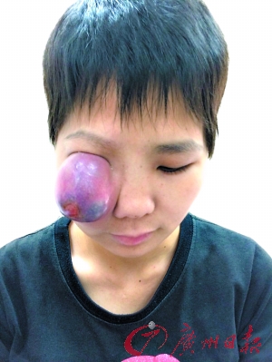 恶性肿瘤苹果大 24岁姑娘右眼被挤瞎