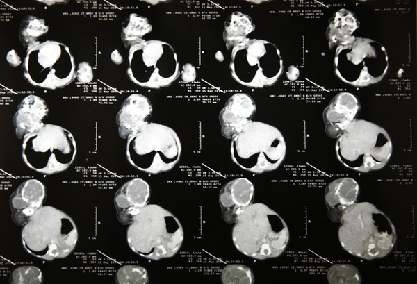 医生说：“这属于寄生双胞胎，女婴身体很健康，有正常心跳，没有其他内部或外部复杂结构，这会增加她幸存的几率。”