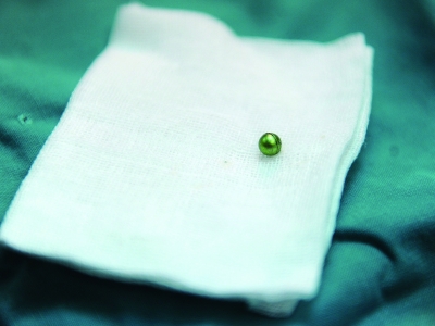 省儿童医院手术室,一颗黄豆大小的塑料玩具子弹从俊俊的气管里取出。本版图片均由记者 郭立亮 摄