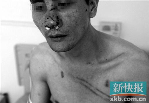 ■潘先生与人发生争执,打斗中被对方咬伤了鼻子。    新快报记者毕志毅/摄