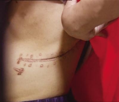 卖肾者展示左肾摘除后遗留的疤痕。