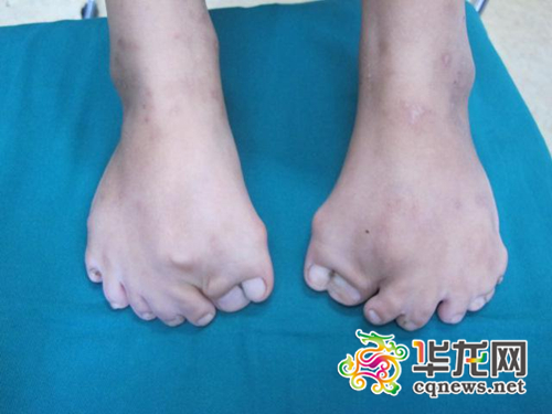 8岁女孩买不到合脚的鞋 原来是长了15根脚趾
