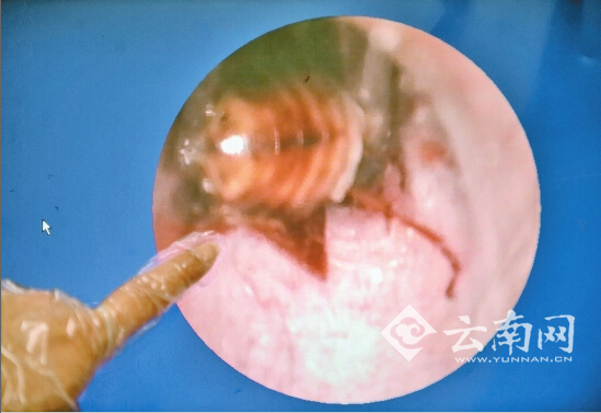 放大顯示鄰近鼓膜處有只活蜜蜂 康生醫(yī)院供圖
