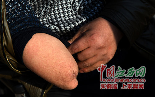因患脉管炎 徐江山的双手双脚只剩下左手四根手指