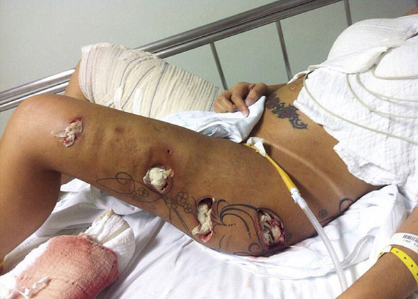 2014年12月份，乌拉赫被曝注射到大腿中的化学填充物腐蚀导致肌肉溃烂。（网页截图）