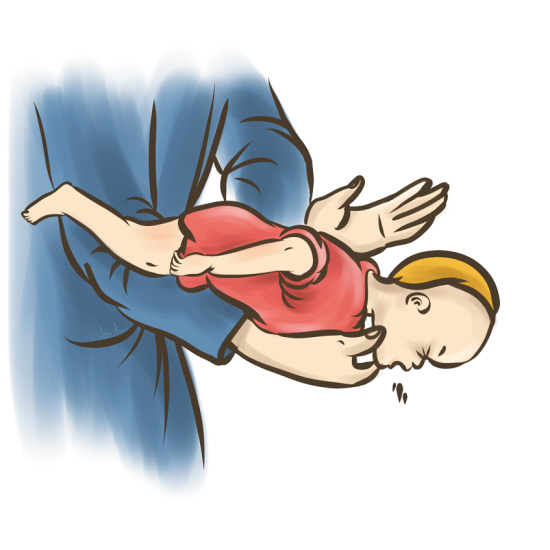 海姆立克急救法家长必学