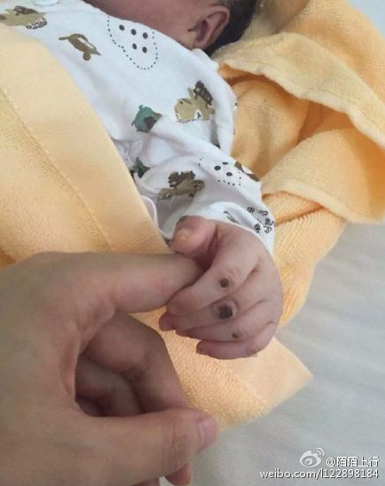 唇腭裂人口_唇腭裂图片