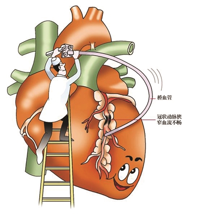 冠心病患者运动应该注意什么