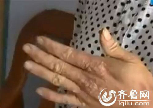 蒙阴男子砷中毒致皮肤长黑斑 自家水井中查出