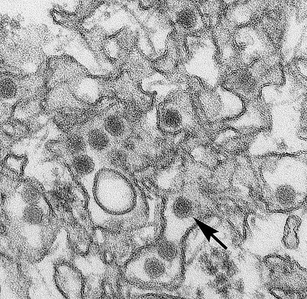 巴西在寨卡患者唾液中发现病毒 疾病或可通过