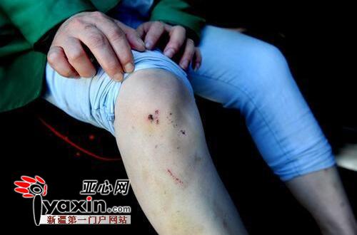 4月25日，程女士身上的伤痕还明显可见。