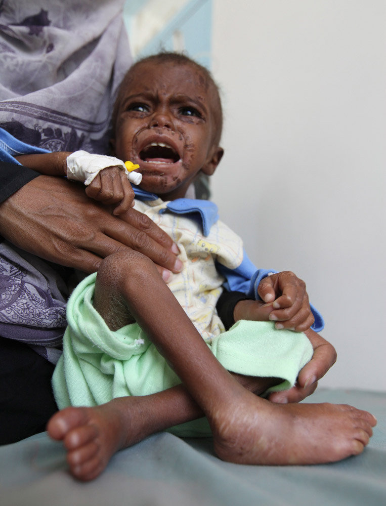 也门近百万儿童遭受营养不良