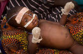 当地时间2012年4月17日，乍得加涅姆区首府Mao的一个医院的营养治疗病房，2岁的Nezile Moussa接受治疗。

