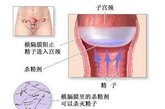 但宫颈位于阴道深部，安放技术不易准确掌握。而且如果官颈帽留置过久，宫颈长时间暴露在分泌物中，容易引起生殖道感染。

