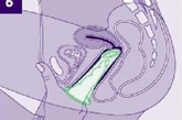 食指套上避孕套，一直往阴道内推送，这期间应确保避孕套主体未被扭曲，而且开口环始终置于阴道口外端。 
