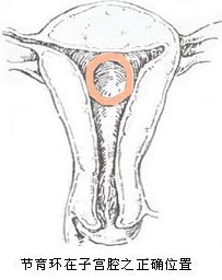 揭秘:女性上环全过程(组图)|宫内节育器|带器妊