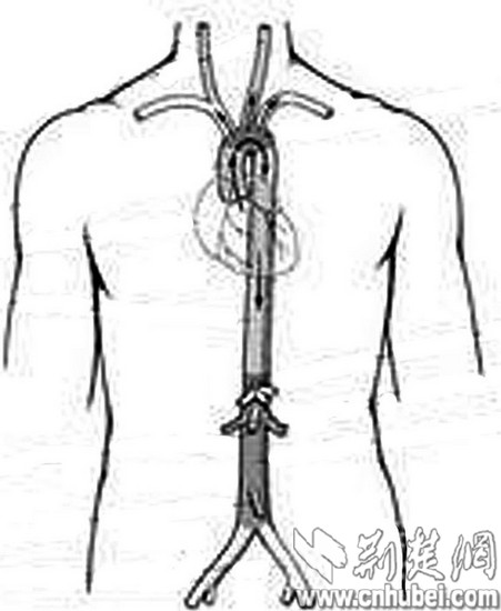 图为:全主动脉被置换人造血管src="http://y1.ifengimg.com/news_spider/dci_2012/04/2fc704927476e718200c6c802126f52e.jpg"