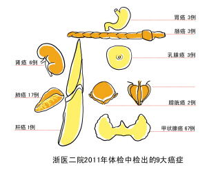 杭州老人高发的前列腺增生会导致前列腺癌吗?
