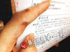 　　张雯的左手食指被老鼠咬伤