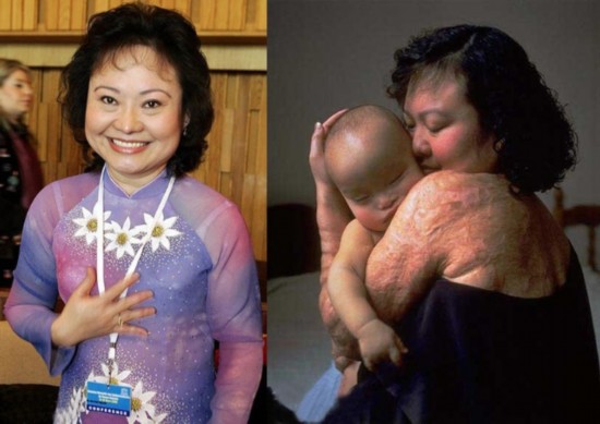 越战中烧伤女孩的命运(组图)