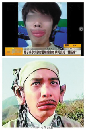 铁岭一男子山中游玩遭蝙蝠强吻嘴唇变香肠(图)