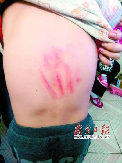 小彭背部留下了明显的血印。