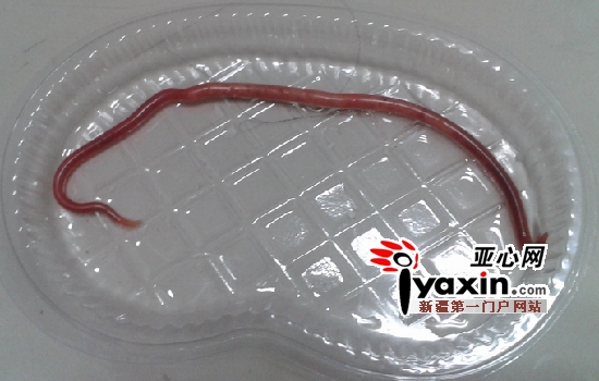 中取出28厘米长蛔虫