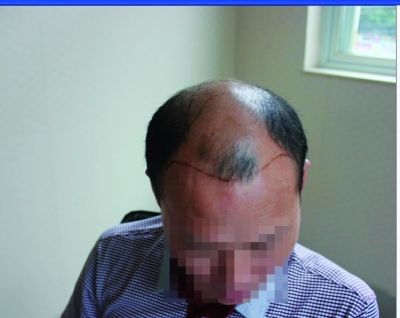 植发不是忽悠,真该早点来!