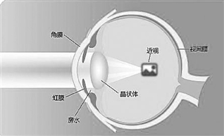 德国专家聊怎么护眼 近视800度以上谨慎做激光手术