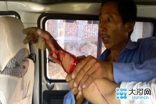 司机右手被绞伤 张亚林 摄