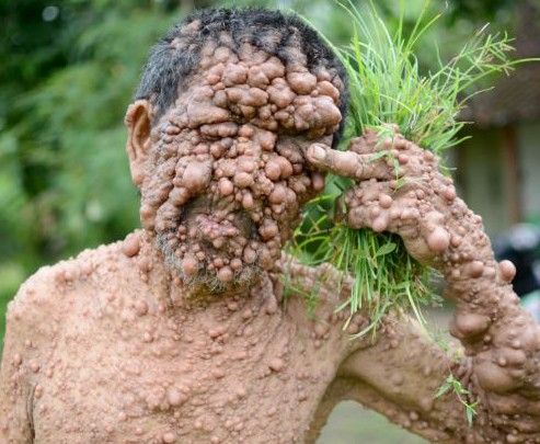 男子全身遍布数百肿瘤致失明