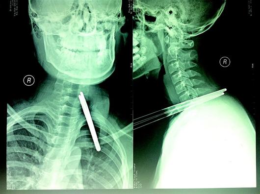 几乎贯穿幸未伤到要害术后已脱离危险