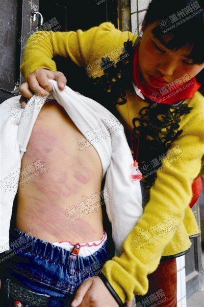 校园 昨天上午,当7岁的小莉(化名)走进学校时,老师发现她的脸上有好几